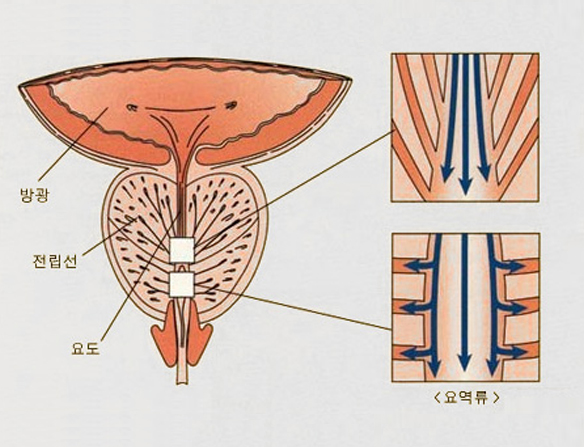 전립선염